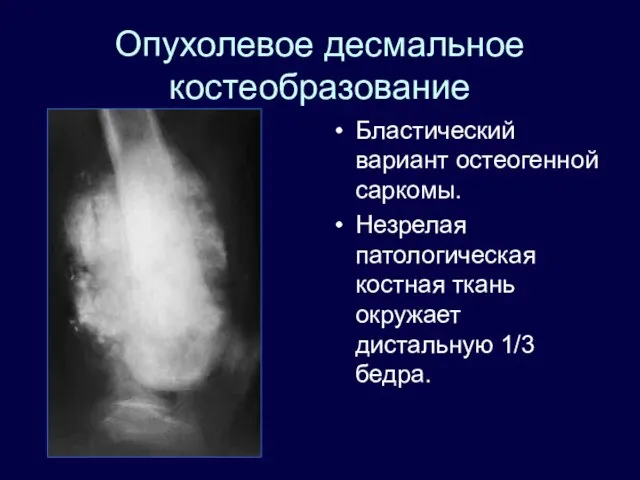 Опухолевое десмальное костеобразование Бластический вариант остеогенной саркомы. Незрелая патологическая костная ткань окружает дистальную 1/3 бедра.