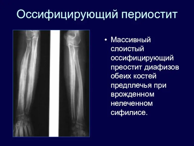 Оссифицирующий периостит Массивный слоистый оссифицирующий преостит диафизов обеих костей предплечья при врожденном нелеченном сифилисе.