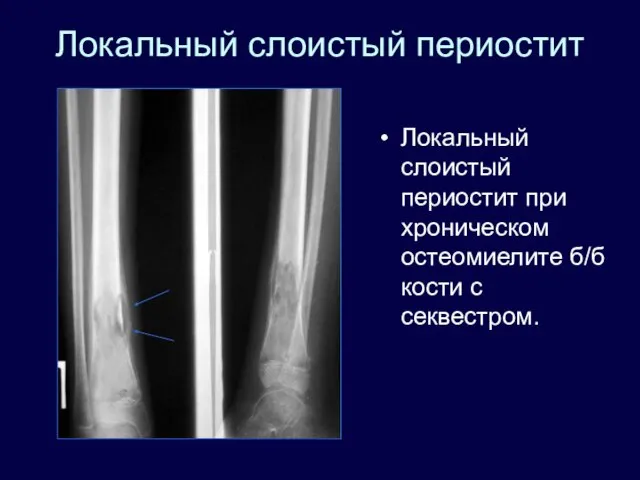 Локальный слоистый периостит Локальный слоистый периостит при хроническом остеомиелите б/б кости с секвестром.