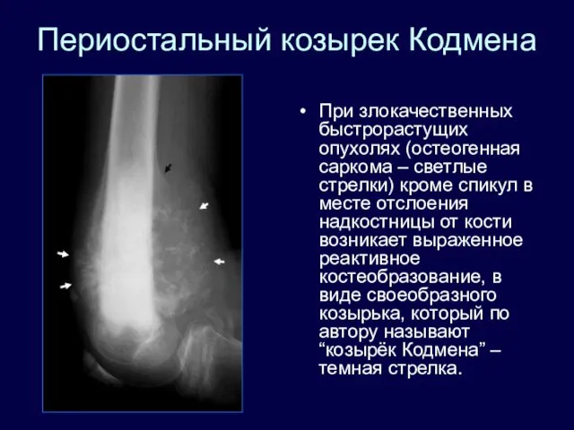 Периостальный козырек Кодмена При злокачественных быстрорастущих опухолях (остеогенная саркома – светлые