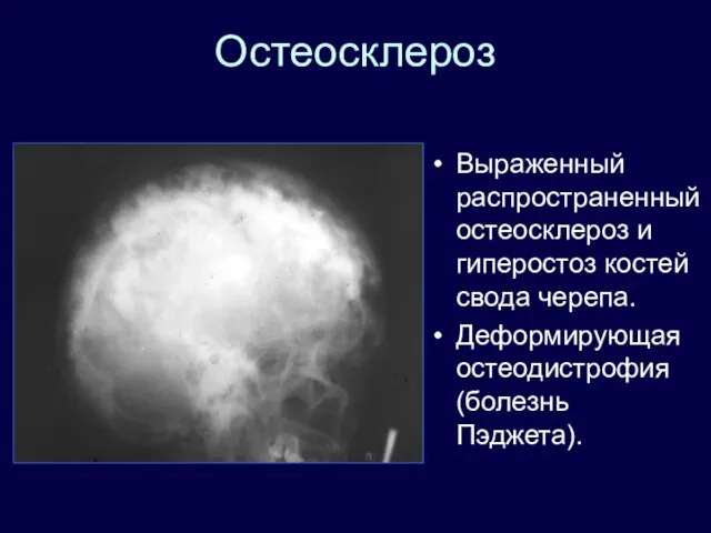 Остеосклероз Выраженный распространенный остеосклероз и гиперостоз костей свода черепа. Деформирующая остеодистрофия (болезнь Пэджета).