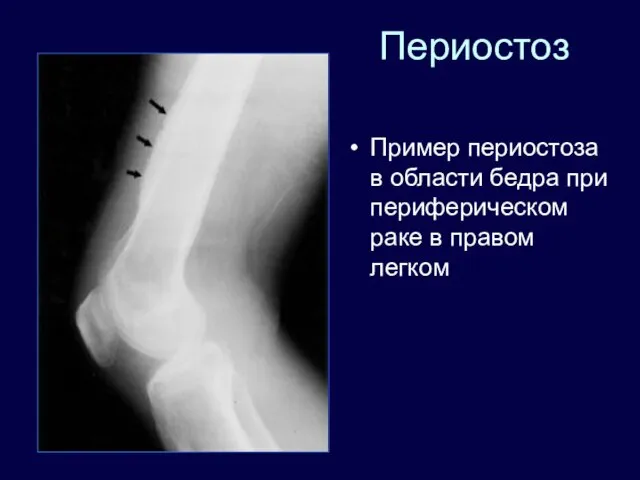 Периостоз Пример периостоза в области бедра при периферическом раке в правом легком