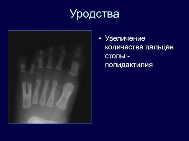 Уродства Увеличение количества пальцев стопы - полидактилия