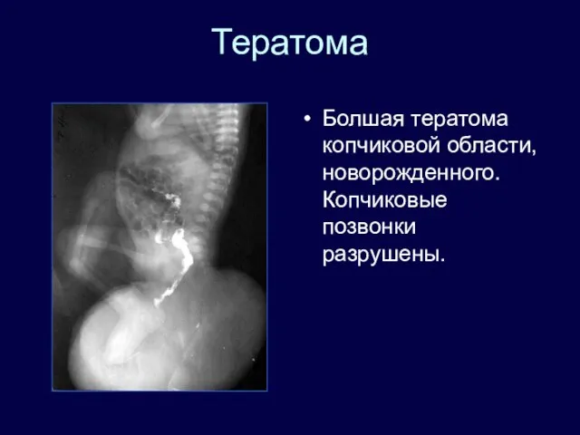 Тератома Болшая тератома копчиковой области, новорожденного. Копчиковые позвонки разрушены.