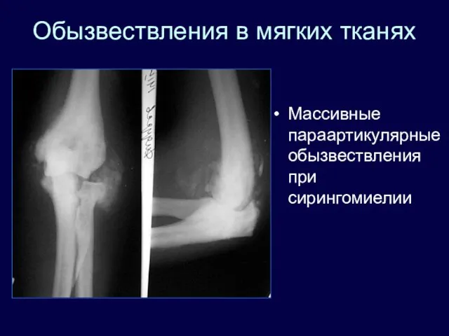 Обызвествления в мягких тканях Массивные параартикулярные обызвествления при сирингомиелии