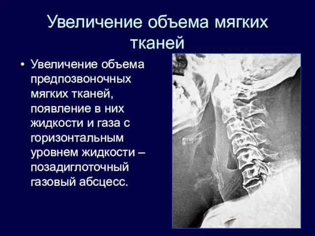 Увеличение объема мягких тканей Увеличение объема предпозвоночных мягких тканей, появление в