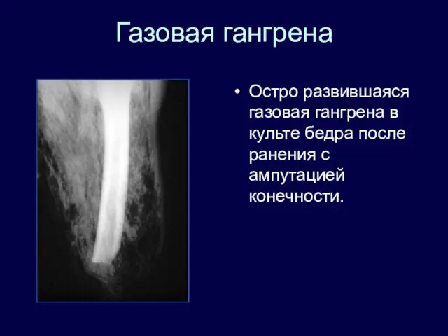 Газовая гангрена Остро развившаяся газовая гангрена в культе бедра после ранения с ампутацией конечности.