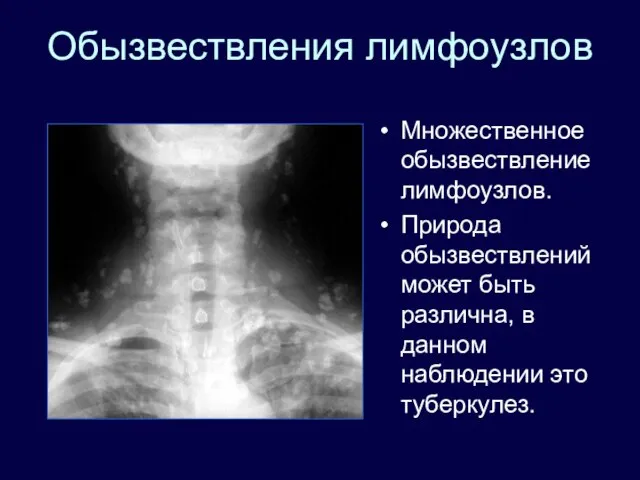 Обызвествления лимфоузлов Множественное обызвествление лимфоузлов. Природа обызвествлений может быть различна, в данном наблюдении это туберкулез.