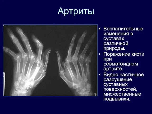 Артриты Воспалительные изменения в суставах различной природы. Поражение кисти при ревматоидном