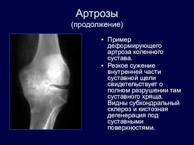 Артрозы (продолжение) Пример деформирующего артроза коленного сустава. Резкое сужение внутренней части