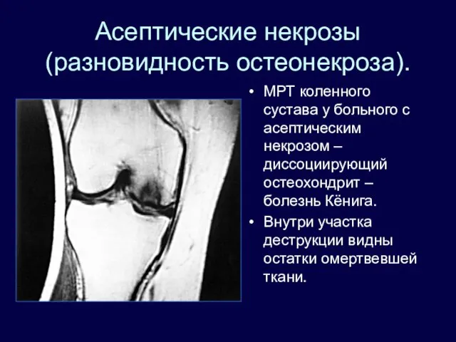 Асептические некрозы (разновидность остеонекроза). МРТ коленного сустава у больного с асептическим