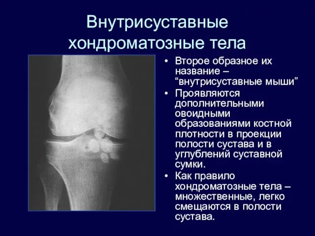 Внутрисуставные хондроматозные тела Второе образное их название – “внутрисуставные мыши” Проявляются