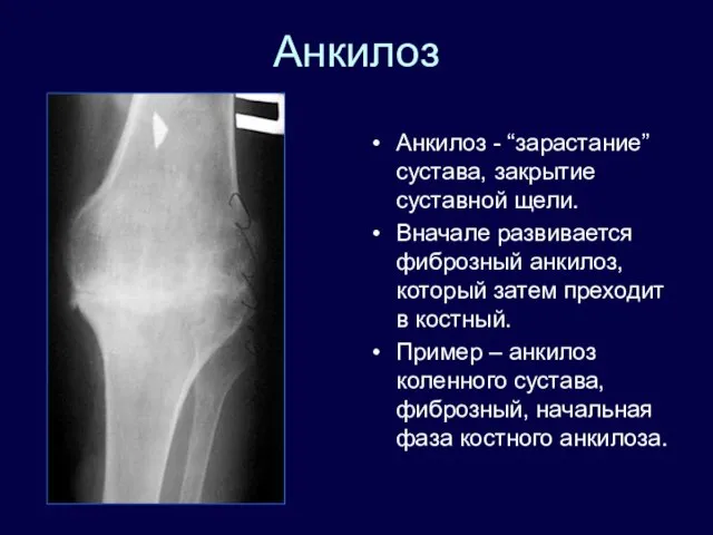 Анкилоз Анкилоз - “зарастание” сустава, закрытие суставной щели. Вначале развивается фиброзный