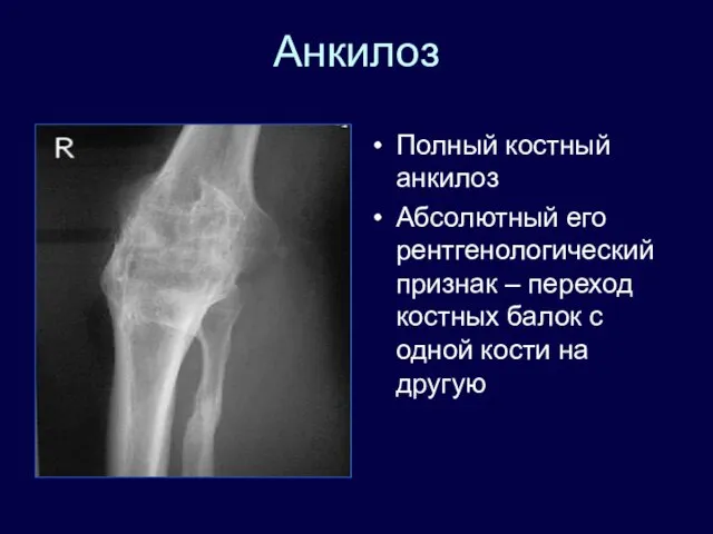 Анкилоз Полный костный анкилоз Абсолютный его рентгенологический признак – переход костных