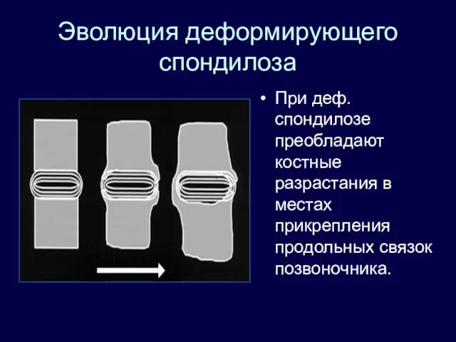 Эволюция деформирующего спондилоза При деф. спондилозе преобладают костные разрастания в местах прикрепления продольных связок позвоночника.