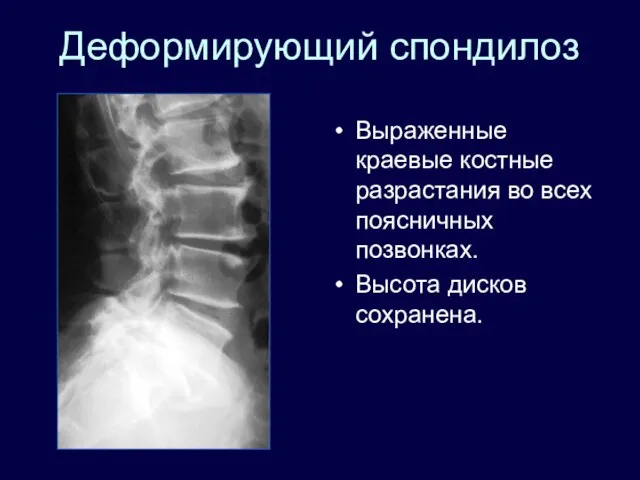 Деформирующий спондилоз Выраженные краевые костные разрастания во всех поясничных позвонках. Высота дисков сохранена.