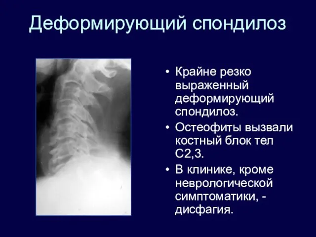 Деформирующий спондилоз Крайне резко выраженный деформирующий спондилоз. Остеофиты вызвали костный блок