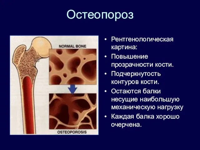 Остеопороз Рентгенологическая картина: Повышение прозрачности кости. Подчеркнутость контуров кости. Остаются балки