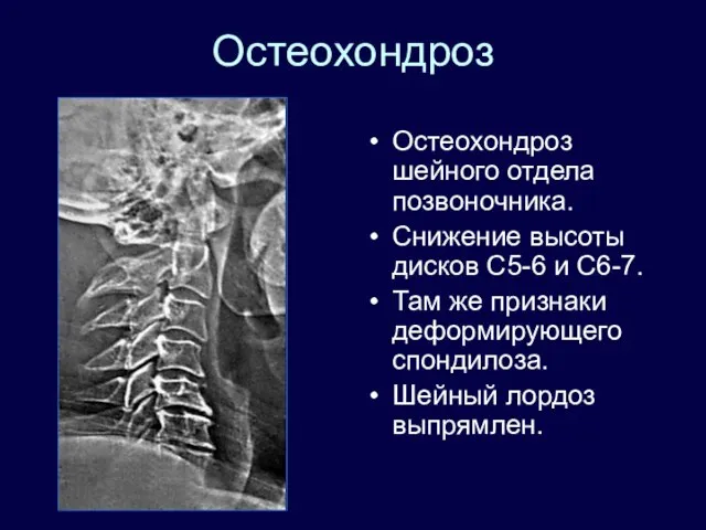 Остеохондроз Остеохондроз шейного отдела позвоночника. Снижение высоты дисков С5-6 и С6-7.