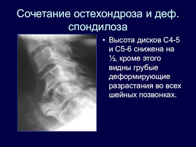 Сочетание остехондроза и деф. спондилоза Высота дисков С4-5 и С5-6 снижена