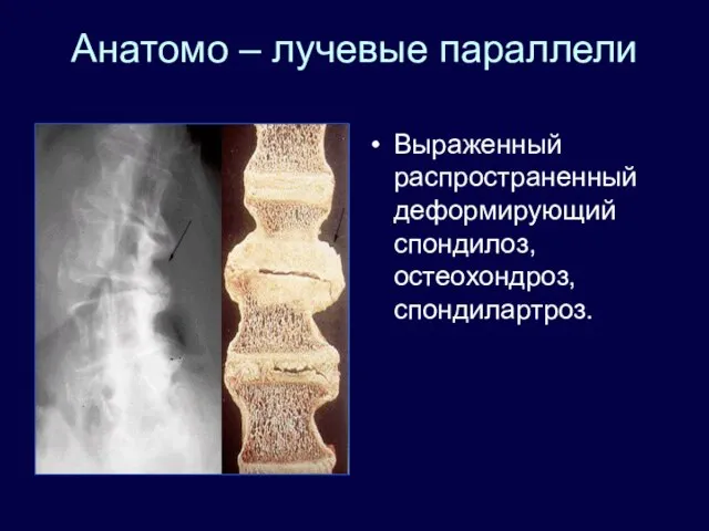 Анатомо – лучевые параллели Выраженный распространенный деформирующий спондилоз, остеохондроз, спондилартроз.