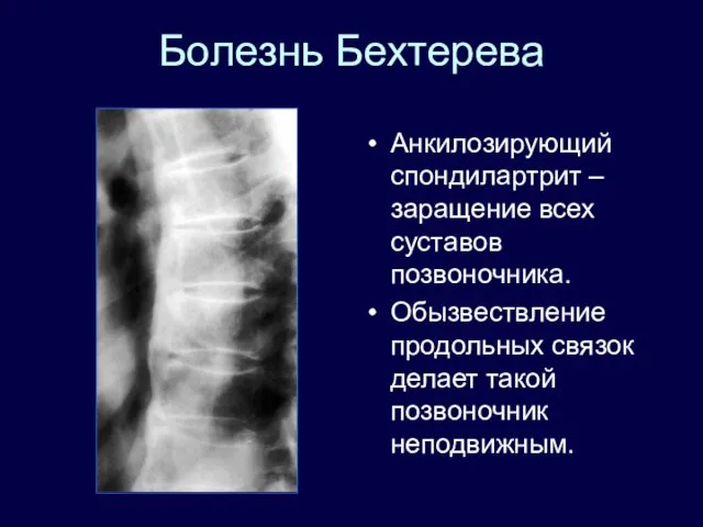 Болезнь Бехтерева Анкилозирующий спондилартрит – заращение всех суставов позвоночника. Обызвествление продольных связок делает такой позвоночник неподвижным.