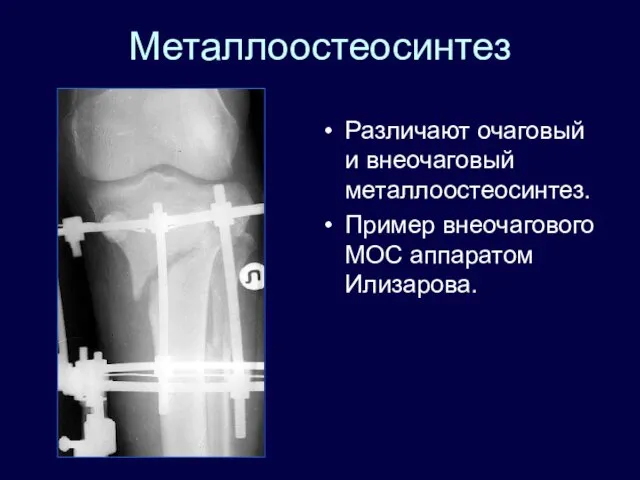 Металлоостеосинтез Различают очаговый и внеочаговый металлоостеосинтез. Пример внеочагового МОС аппаратом Илизарова.