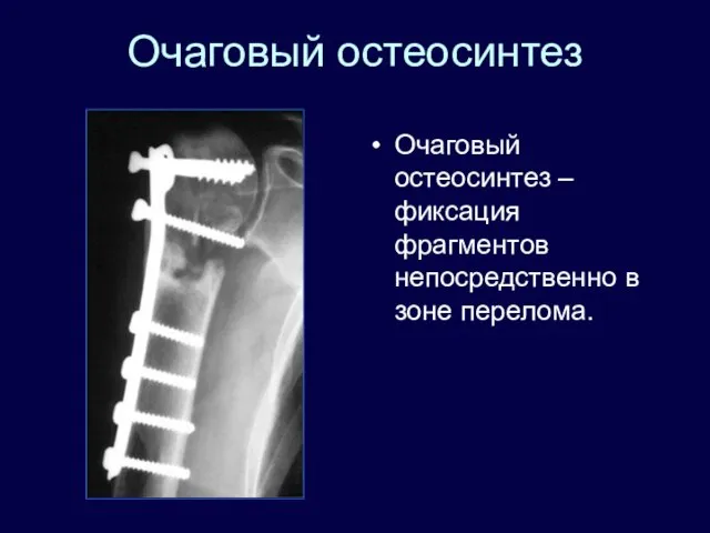 Очаговый остеосинтез Очаговый остеосинтез – фиксация фрагментов непосредственно в зоне перелома.