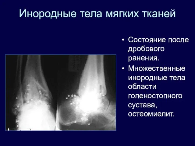 Инородные тела мягких тканей Состояние после дробового ранения. Множественные инородные тела области голеностопного сустава, остеомиелит.