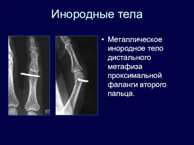 Инородные тела Металлическое инородное тело дистального метафиза проксимальной фаланги второго пальца.