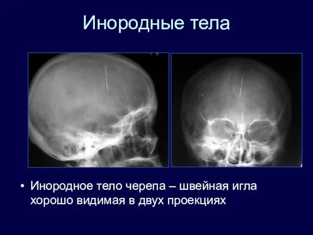 Инородные тела Инородное тело черепа – швейная игла хорошо видимая в двух проекциях