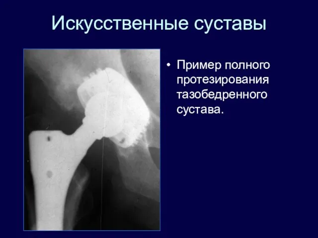 Искусственные суставы Пример полного протезирования тазобедренного сустава.