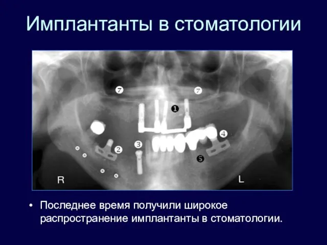 Имплантанты в стоматологии Последнее время получили широкое распространение имплантанты в стоматологии.