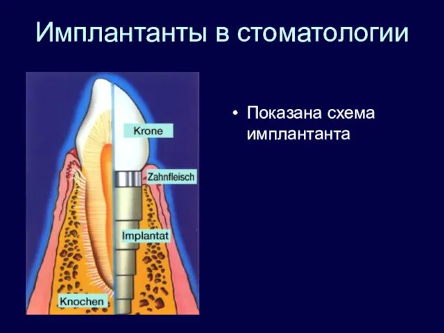 Имплантанты в стоматологии Показана схема имплантанта