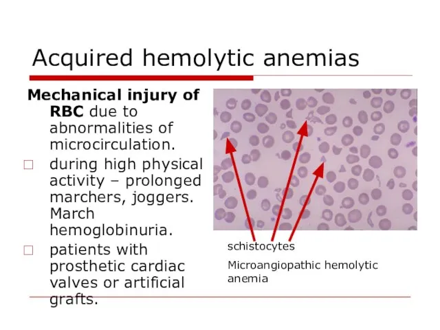 Acquired hemolytic anemias Mechanical injury of RBC due to abnormalities of