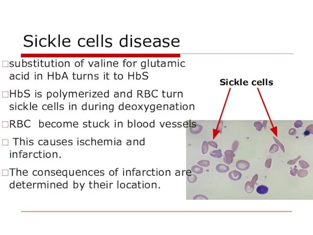 Sickle cells disease substitution of valine for glutamic acid in HbA