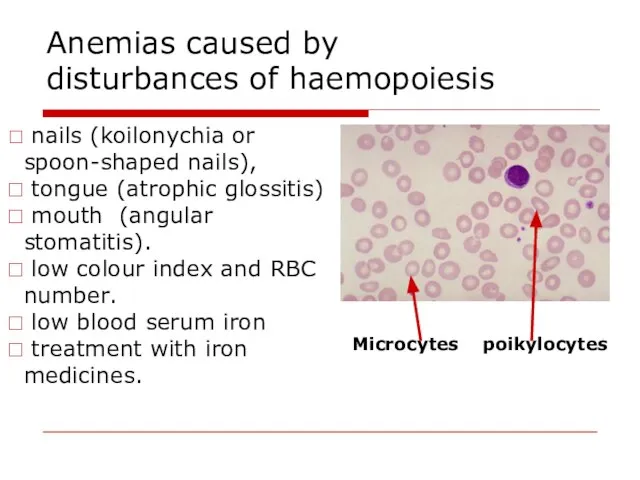 Anemias caused by disturbances of haemopoiesis nails (koilonychia or spoon-shaped nails),