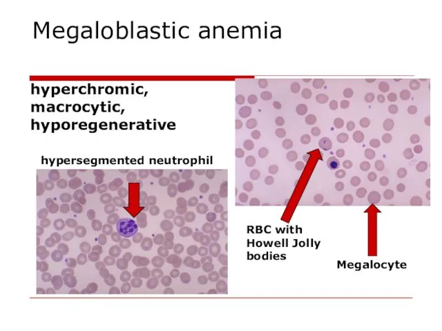 Megaloblastic anemia hyperchromic, macrocytic, hyporegenerative hypersegmented neutrophil RBC with Howell Jolly bodies Megalocyte
