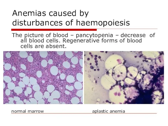 Anemias caused by disturbances of haemopoiesis The picture of blood –