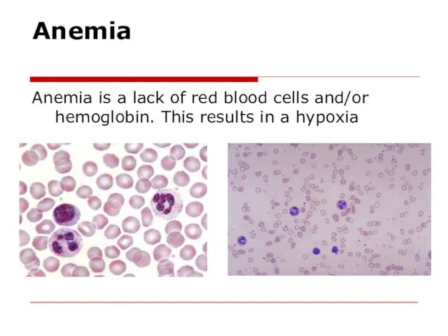 Anemia Anemia is a lack of red blood cells and/or hemoglobin. This results in a hypoxia