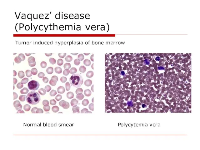 Vaquez’ disease (Polycythemia vera) Tumor induced hyperplasia of bone marrow Normal blood smear Polycytemia vera