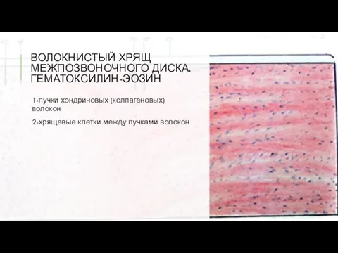 ВОЛОКНИСТЫЙ ХРЯЩ МЕЖПОЗВОНОЧНОГО ДИСКА. ГЕМАТОКСИЛИН-ЭОЗИН 1-пучки хондриновых (коллагеновых) волокон 2-хрящевые клетки между пучками волокон