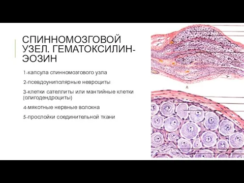 СПИННОМОЗГОВОЙ УЗЕЛ. ГЕМАТОКСИЛИН-ЭОЗИН 1-капсула спинномозгового узла 2-псевдоуниполярные невроциты 3-клетки сателлиты или