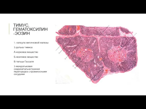 ТИМУС. ГЕМАТОКСИЛИН-ЭОЗИН 1- капсула вилочковой железы 2-долька тимиса А-корковое вещество Б-мозговое