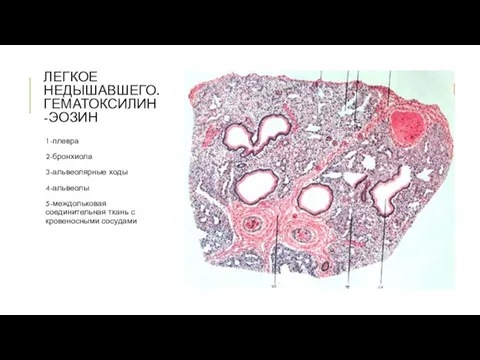 ЛЕГКОЕ НЕДЫШАВШЕГО. ГЕМАТОКСИЛИН-ЭОЗИН 1-плевра 2-бронхиола 3-альвеолярные ходы 4-альвеолы 5-междольковая соединительная ткань с кровеносными сосудами