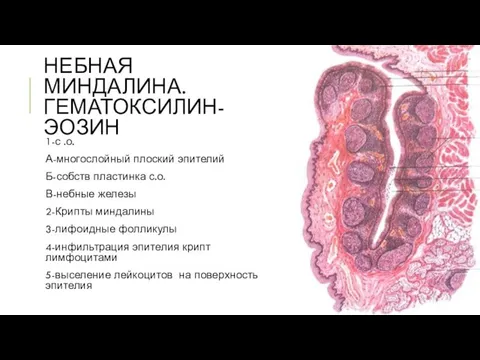 НЕБНАЯ МИНДАЛИНА. ГЕМАТОКСИЛИН-ЭОЗИН 1-с .о. А-многослойный плоский эпителий Б-собств пластинка с.о.