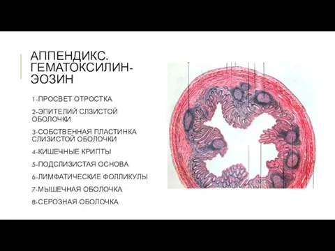 АППЕНДИКС. ГЕМАТОКСИЛИН-ЭОЗИН 1-ПРОСВЕТ ОТРОСТКА 2-ЭПИТЕЛИЙ СЛЗИСТОЙ ОБОЛОЧКИ 3-СОБСТВЕННАЯ ПЛАСТИНКА СЛИЗИСТОЙ ОБОЛОЧКИ