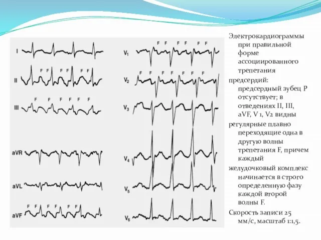 Электрокардиограммы при правильной форме ассоциированного трепетания предсердий: предсердный зубец Р отсутствует;