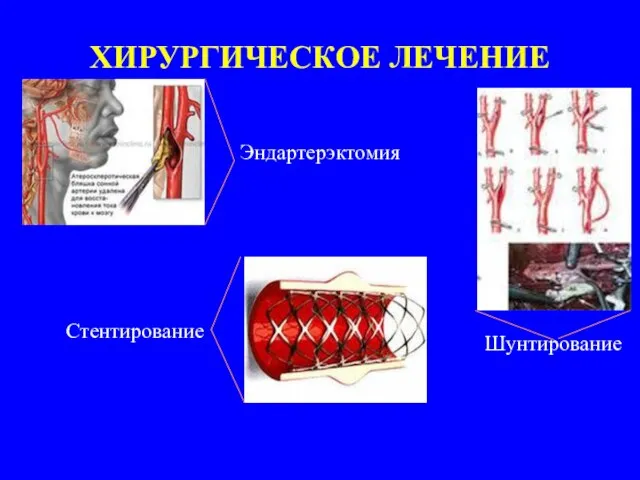 ХИРУРГИЧЕСКОЕ ЛЕЧЕНИЕ Эндартерэктомия Стентирование Шунтирование