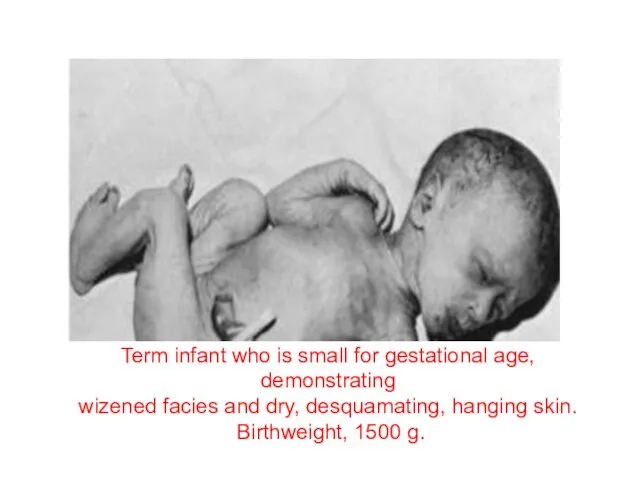 Term infant who is small for gestational age, demonstrating wizened facies
